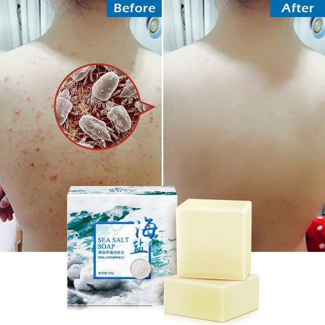 Acne Treatment Sea Salt Soap - wnkrs