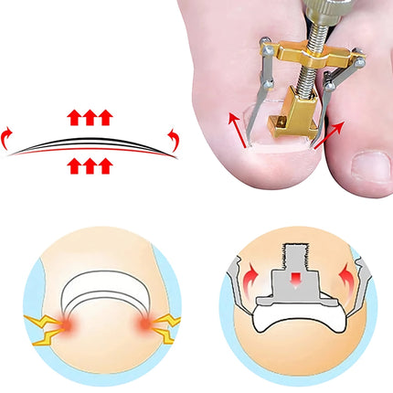 Kit de tratamiento profesional para uñas encarnadas con parches correctores y herramientas de pedicura