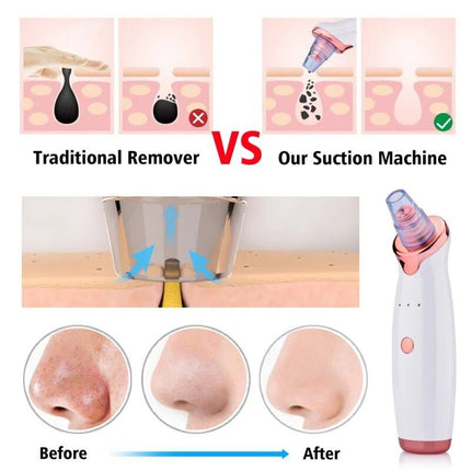 Electric Facial Vacuum Blackhead & Acne Remover with Deep Pore Cleansing - Wnkrs