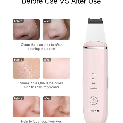 Ultrasonic Skin Scrubber | Deep Cleansing Facial Peeling Shovel | Pore and Blackhead Removal Tool